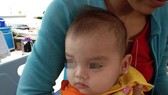 Đến nay, sức khỏe bé đã ổn định, bé được xuất viện với gương mặt lành lặn