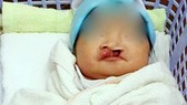 Xót xa bé gái sơ sinh hở hàm ếch bị bỏ rơi giữa chợ