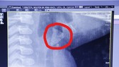 Hình ảnh mảnh xương mắc ở vùng thanh quản bệnh nhi Kh.