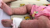 Hà Nội hơn 1.000 người mắc sởi