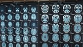 Hình ảnh chẩn đoán nhồi máu não của người đàn ông nước ngoài