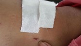 Vết khoan 'nhầm' của BS đối với bệnh nhân bị gãy đốt sống ngực. Ảnh: Tiền Phong online