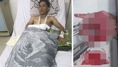 Anh Hạnh với vết thương trên người.