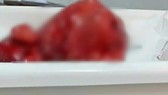 Phẫu thuật thành công khối u xơ nặng 4,5kg trong tử cung người phụ nữ 60 tuổi