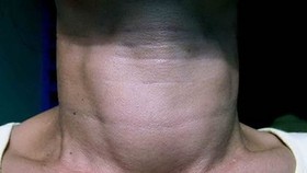 Vietnam one of top iodine-deficient countries