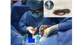 các bác sĩ đang tiến hành phẫu thuật lấy dị vật