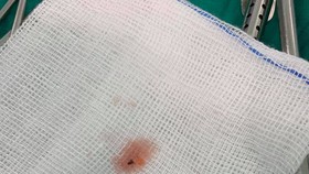 Viên đạn súng săn được lấy ra từ trong người bệnh nhi