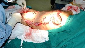 Cấp cứu thành công một công nhân bị lột da khi ngã vào máy bóc gỗ