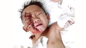 Xót thương cháu bé bị bỏng toàn thân