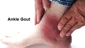 Cách mới chữa trị sỏi thận và bệnh gout