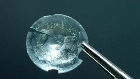 Kính áp tròng kẹt trong mắt suốt 28 năm
