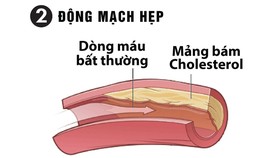 Ổn định huyết áp, tránh xa các biến chứng