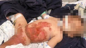 Increase in hospitalizations of burned kids