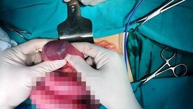 Young man has tapioca beads in intestine because of often drinking milk tea