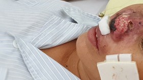 Four people die of rare Whitmore’s disease in North Vietnam