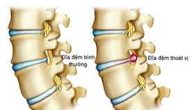 Đắp thuốc, nắn xương, bấm huyệt không chữa được thoát vị đĩa đệm