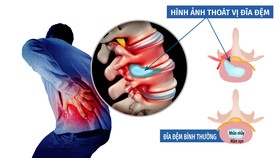 Thoát vị đĩa đệm, bệnh của cuộc sống hiện đại