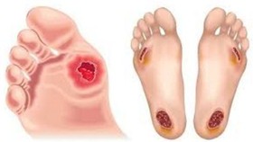 Ít nhất 80 người tử vong mỗi ngày vì biến chứng đái tháo đường