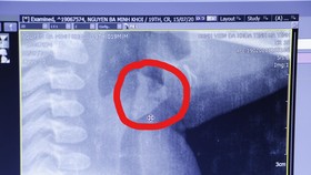 Hình ảnh mảnh xương mắc ở vùng thanh quản bệnh nhi Kh.