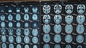 Hình ảnh chẩn đoán nhồi máu não của người đàn ông nước ngoài