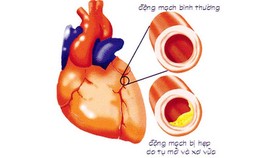 Chớ coi thường bệnh xơ vữa động mạch