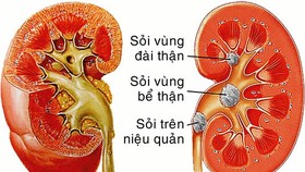Điều trị sỏi thận không xâm lấn bằng phương pháp tán sỏi ngoài cơ thể