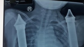 Cứu cháu bé bị thanh sắt hàng rào đâm thấu ngực