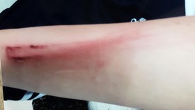 Mồ côi mẹ, bé gái 12 tuổi bị cha ruột đánh phải nhập viện