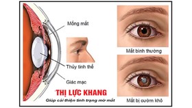 Các bệnh về mắt