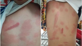 Khởi tố vụ án cô ruột đánh cháu thương tích 13%