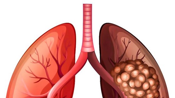 Ung thư phổi-Nguy cơ mắc bệnh cao