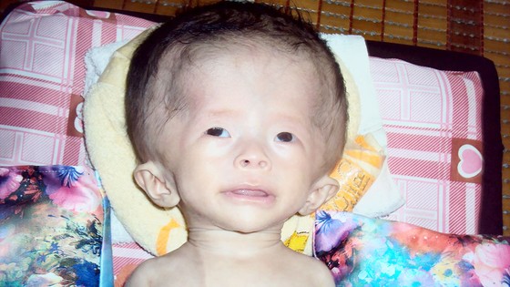 Bé 3 tháng tuổi bị bệnh não úng thủy