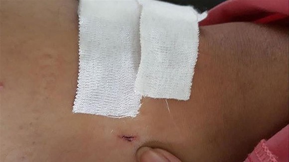 Vết khoan 'nhầm' của BS đối với bệnh nhân bị gãy đốt sống ngực. Ảnh: Tiền Phong online