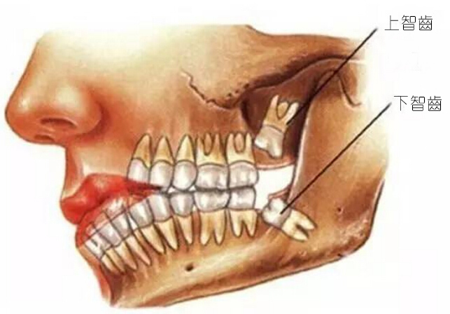 什麼样的智齿必须拔掉