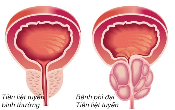 Bí kíp Dứt điểm phì đại tiền liệt tuyến không cần phẫu thuật ảnh 1