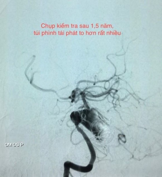 Can thiệp mạch máu não không cần gây mê ảnh 1