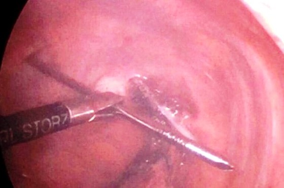 Hy hữu đinh dài 12 cm đâm xuyên đỉnh phổi chui vào tủy sống...vẫn sống ảnh 1