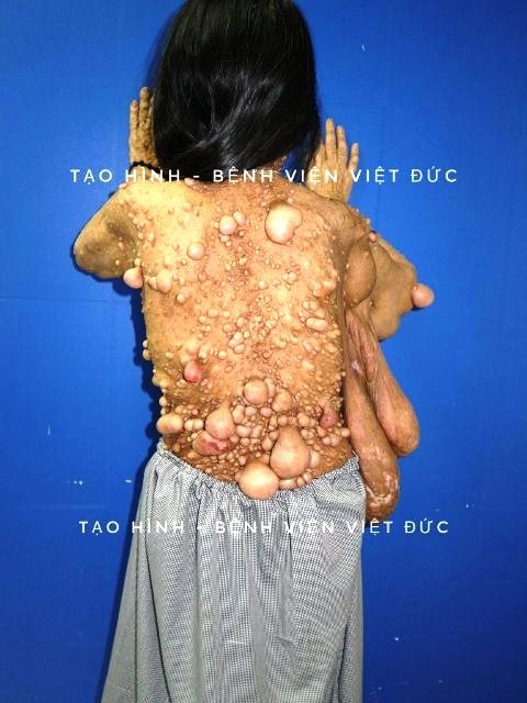 Phẫu thuật cho người phụ nữ có hàng trăm khối u xơ trên người ảnh 1