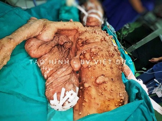 Phẫu thuật cho người phụ nữ có hàng trăm khối u xơ trên người ảnh 2