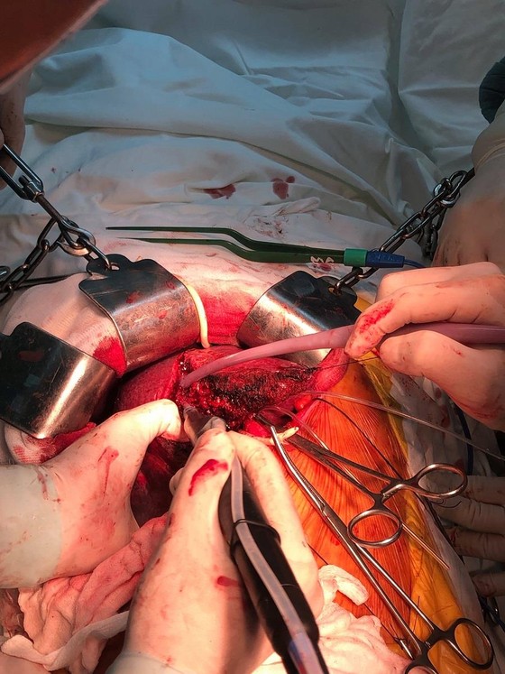 Lần đầu cắt gan bằng kỹ thuật bảo tồn ở Bệnh viện Trung ương Huế ảnh 2