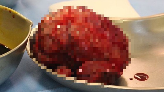 Phẫu thuật cắt u gan cho bệnh nhi, với yêu cầu “không được truyền máu của người khác” ảnh 2