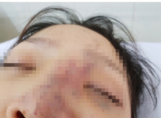 Tiêm filler giá rẻ, nữ sinh viên có nguy cơ mù mắt ảnh 1