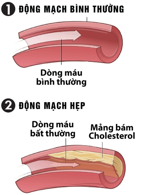 Ổn định huyết áp, tránh xa các biến chứng ảnh 1