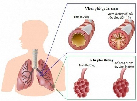 Phòng ngừa bệnh phổi tắc nghẽn mạn tính ảnh 1