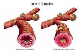 Hen phế quản và cách phòng ngừa hiệu quả ảnh 1