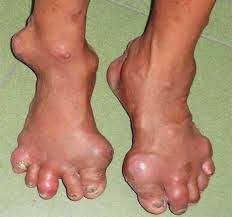 Một số bệnh thường gặp ở người cao tuổi và biện pháp phòng bệnh ảnh 5