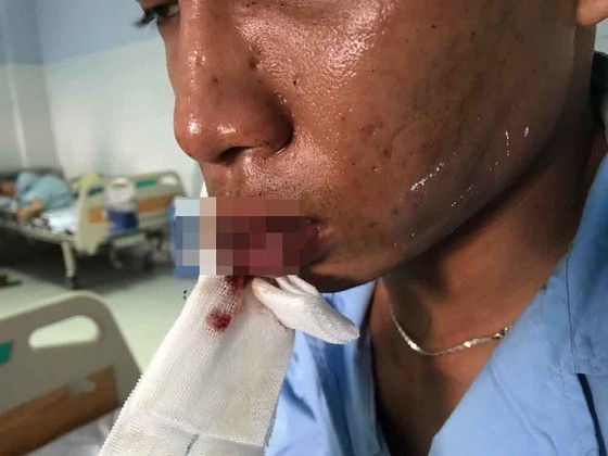 Bắt nhóm đối tượng nghi đòi bảo kê chém nhân viên quán cà phê nhập viện ảnh 2
