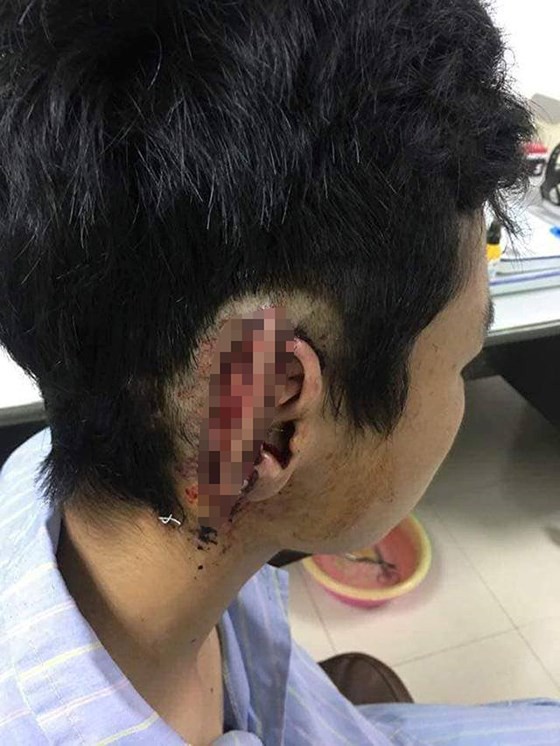 Học sinh bất ngờ bị bạn cùng trường cắn đứt và nhai nuốt vành tai ảnh 1