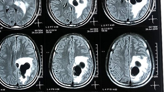 Phẫu thuật thành công cho bệnh nhân bị sán làm ổ trong não ảnh 1