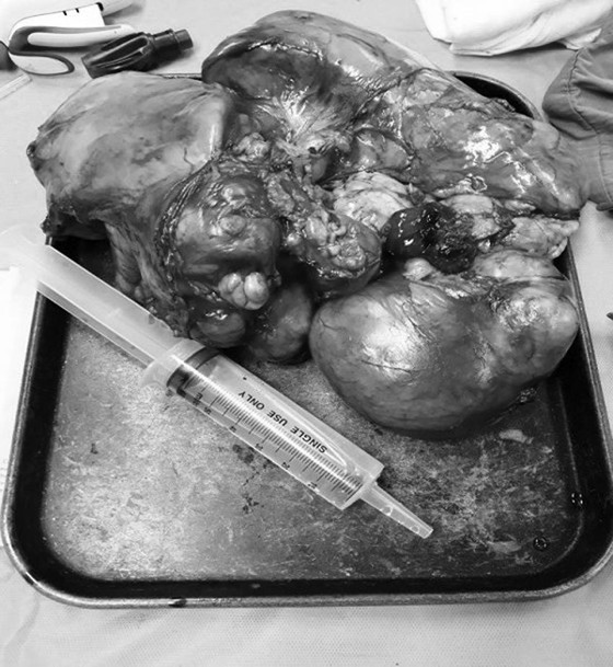 Phẫu thuật thành công khối u trung thất đến 4 kg ảnh 2